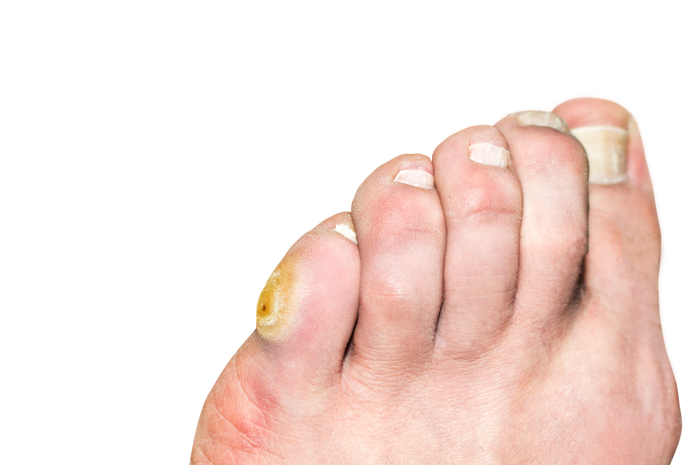 toe fungus