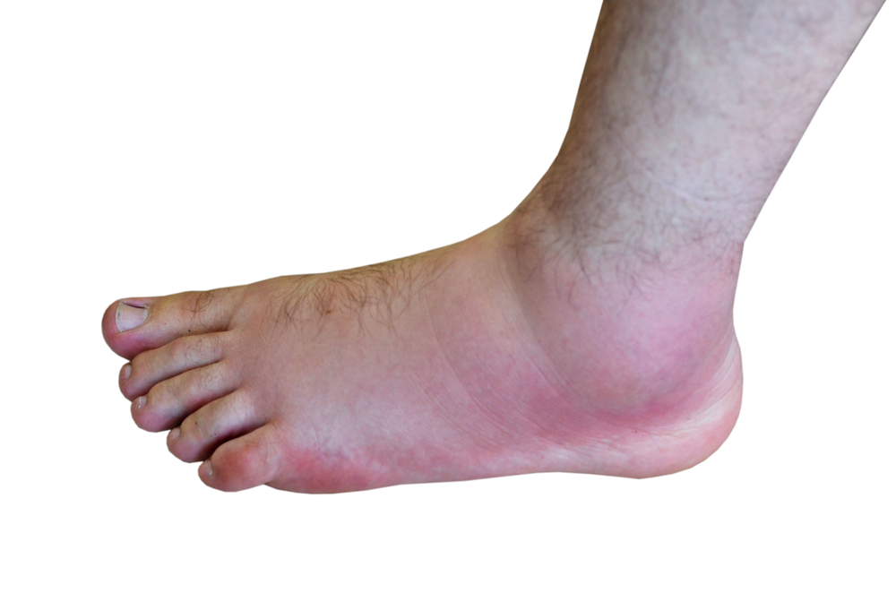 inflamed foot